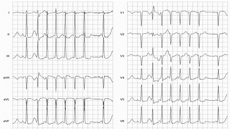 Supraventricular Tachycardia12 Lead EKG